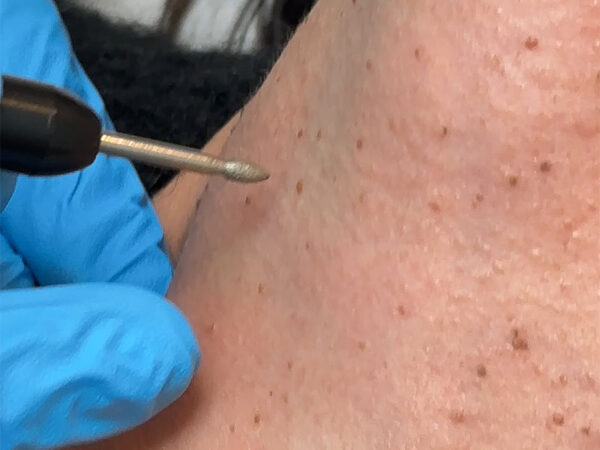 électrocoagulation de micro lésions bénigne visage et corps 